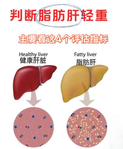 查出脂肪肝，严不严重？4个评估帮你判断病情！1、CAP值超声弹性报告里的“脂