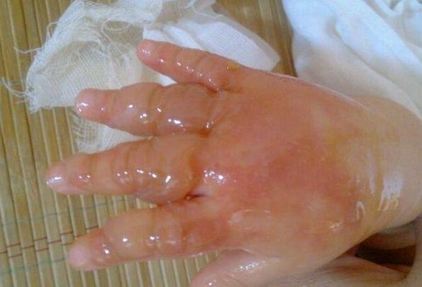 2岁宝宝右手烫伤流脓, 家里的这玩意一定别放在孩子跟前! 太害人