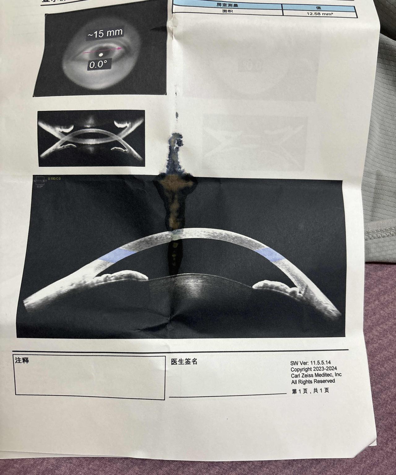 检查完了，急性青光眼，直接让住院手术，我有点不相信北海的技术，选择回黑龙江再说。