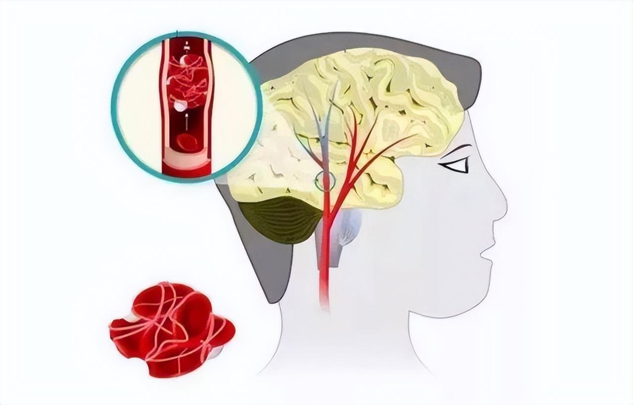 脑梗不是突然来临的，睡觉时出现这3种迹象，或是“前兆”信号夜里本该是身体恢复
