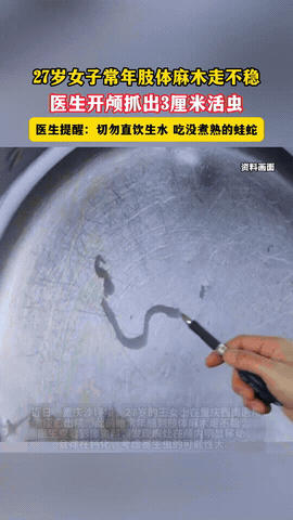 真是不可思议！重庆，王女士头疼了5年，常年肢体麻木，走路不稳，跑遍了各个大小