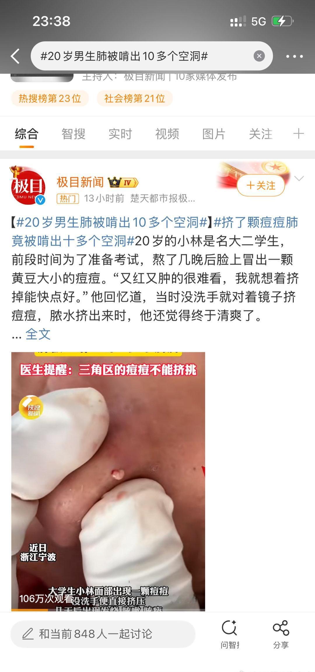 啊？虽然我不常长痘，但是一旦长痘必挤掉[捂脸哭]仗着自己不留痘印有恃无恐​