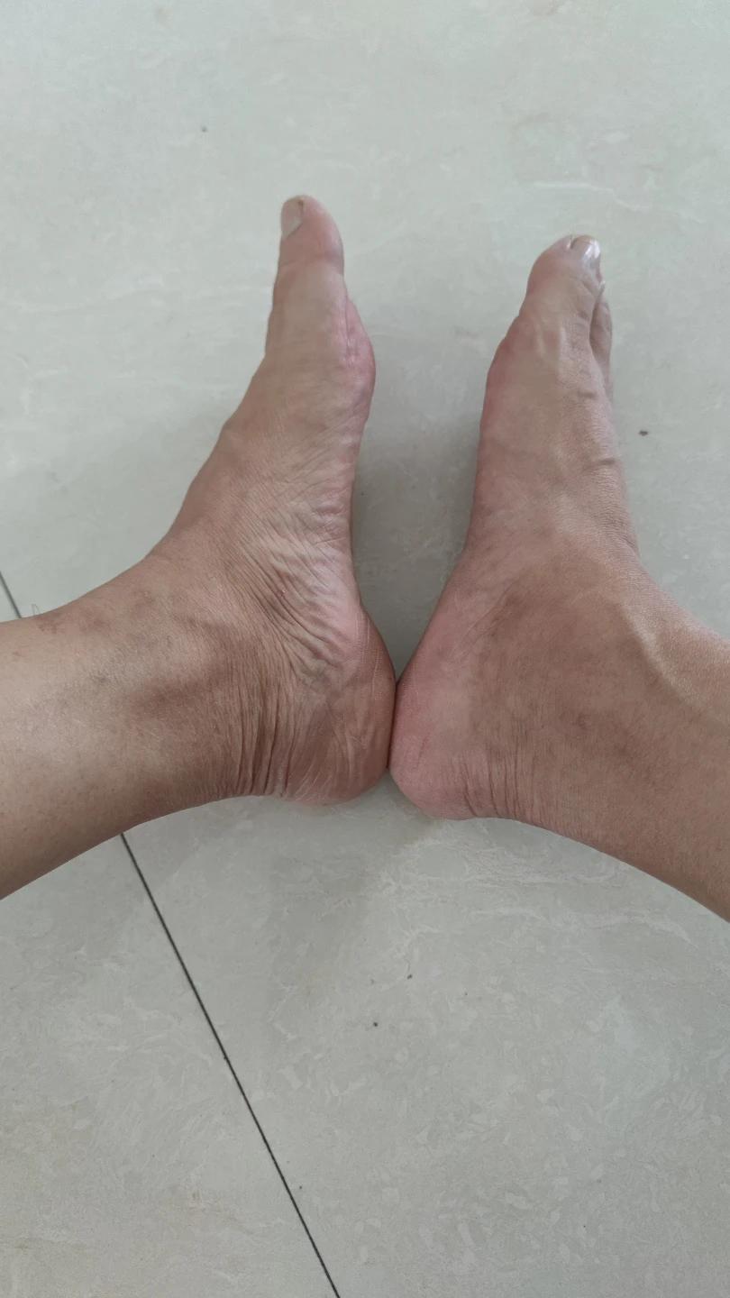 右脚内踝肿的莫名其妙，不痛，早上起来不得劲，走一走就好了，这是痛风吗？