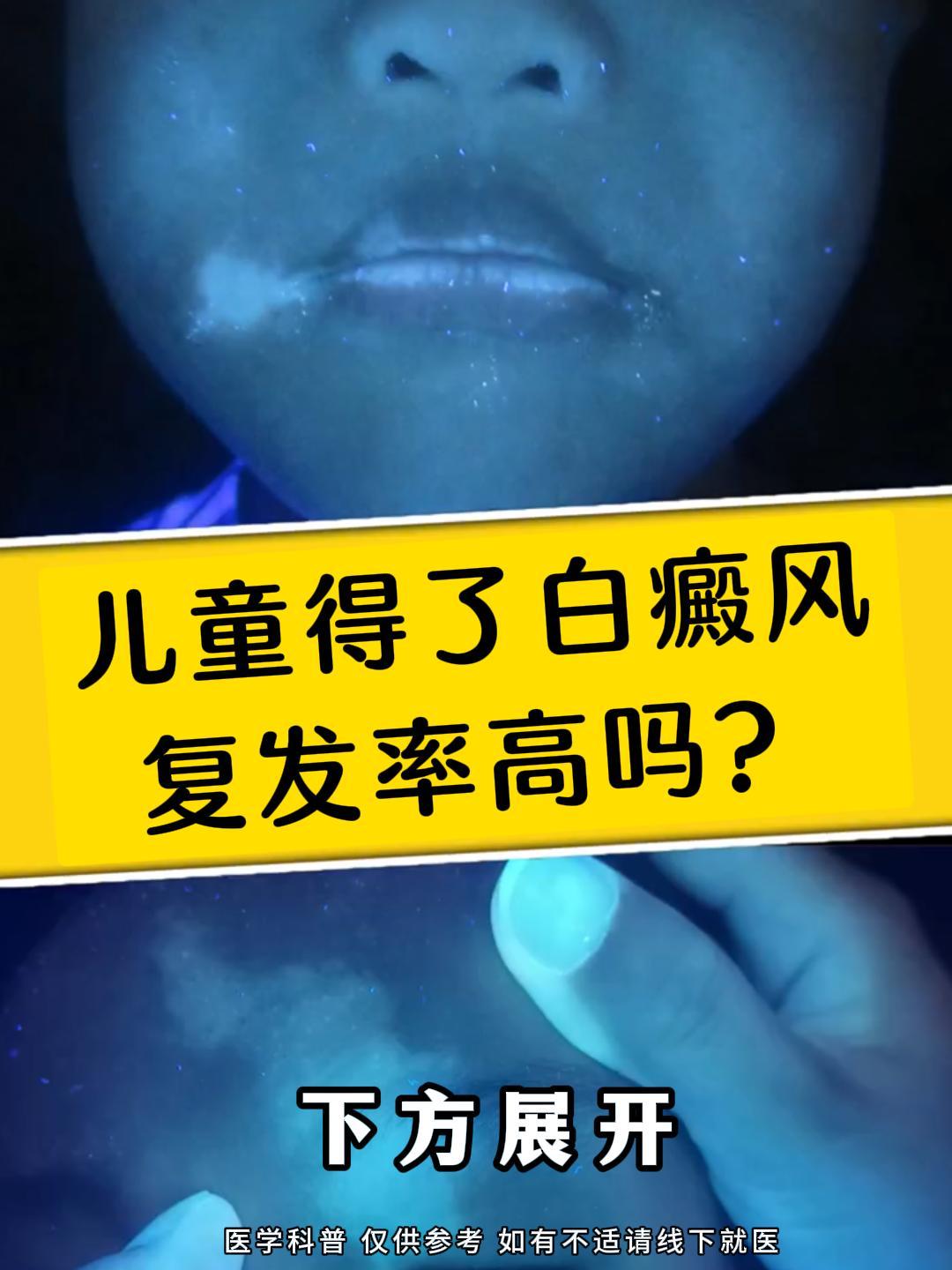 儿童白癜风复发几率存在一定不确定性，会受多种因素影响。  从临床情况看...