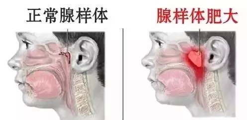 山西惠民耳鼻喉专家: 眉清目秀五官端正的孩子怎么就越长越丑? 小心腺样体肥大是罪魁祸首