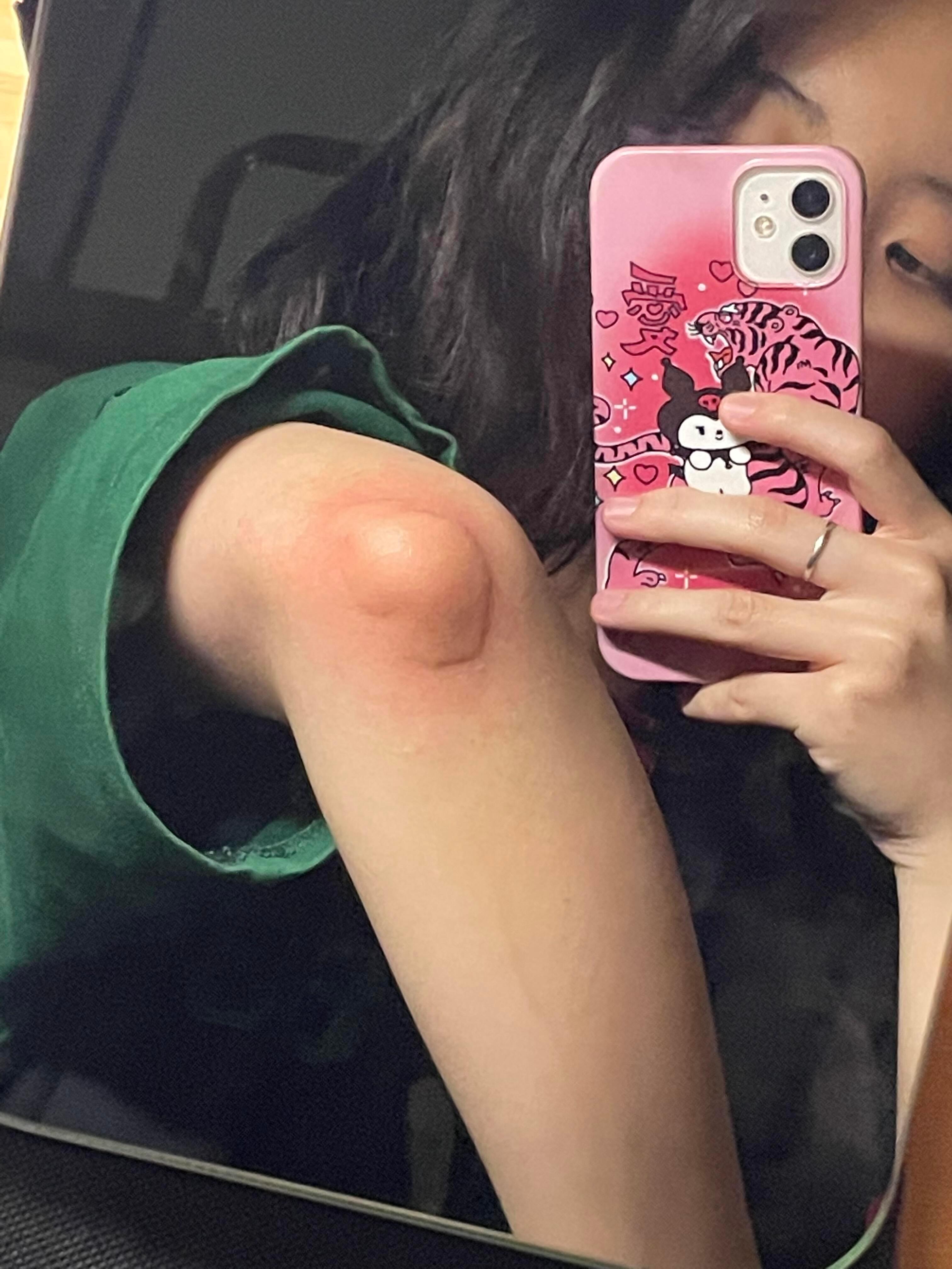 这是什么雷霆嘎巴蚊子能咬这么大个包