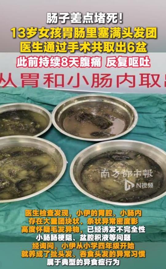 13岁女孩的胃里，竟取出6盆头发！真相让所有家长沉默。 这事发生在广东