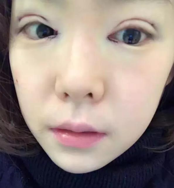 做了双眼皮和开眼角, 取悦自己永远比取悦任何人来得更纯粹