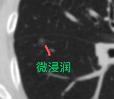 50岁女性双肺多发结节，随访发现变化急就医，术后终安心！山东的杨女士，半年前体检