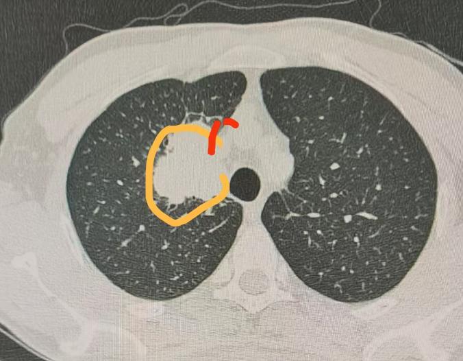 刚完成一台右上肺癌手术，这位患者一周前，曾在外院接受过肺癌手术，但因为术中医生发