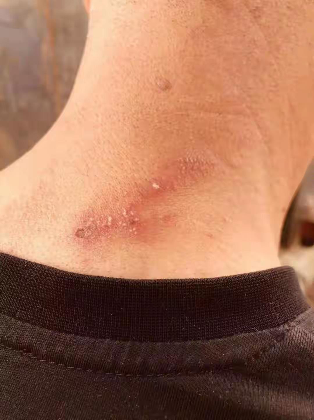 浙江台州，20多岁男子开着窗，穿着宽松短裤睡觉，次日突然感觉大腿根隐隐刺痛，他以