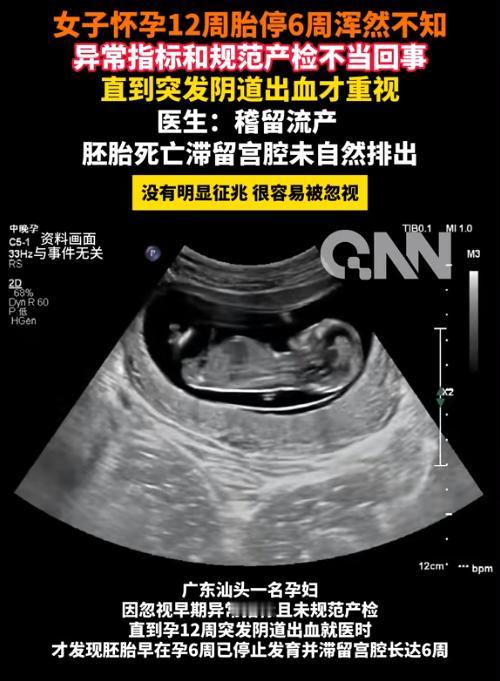 “心真大！”广东汕头一女子怀孕12周突然出血，紧急送医后竟被告知，胎儿早在6周前