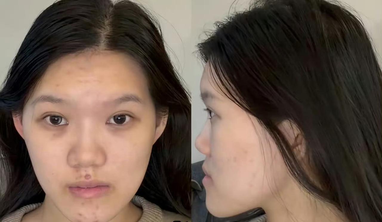 刷到个让人后背发凉的事，武汉24岁的姑娘小雨本来只是有点轻微地包天，下颌只需要后