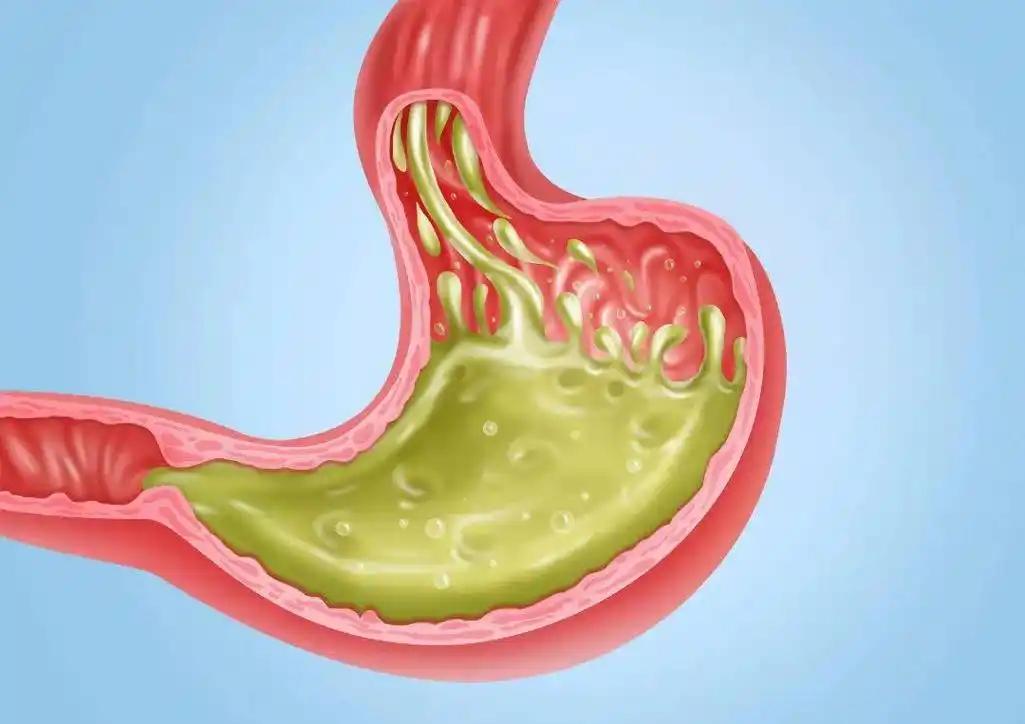 胃粘膜的“保护伞”，常吃胃粘膜完整如初，远离胃病！胃粘膜一旦出问题，整个胃就