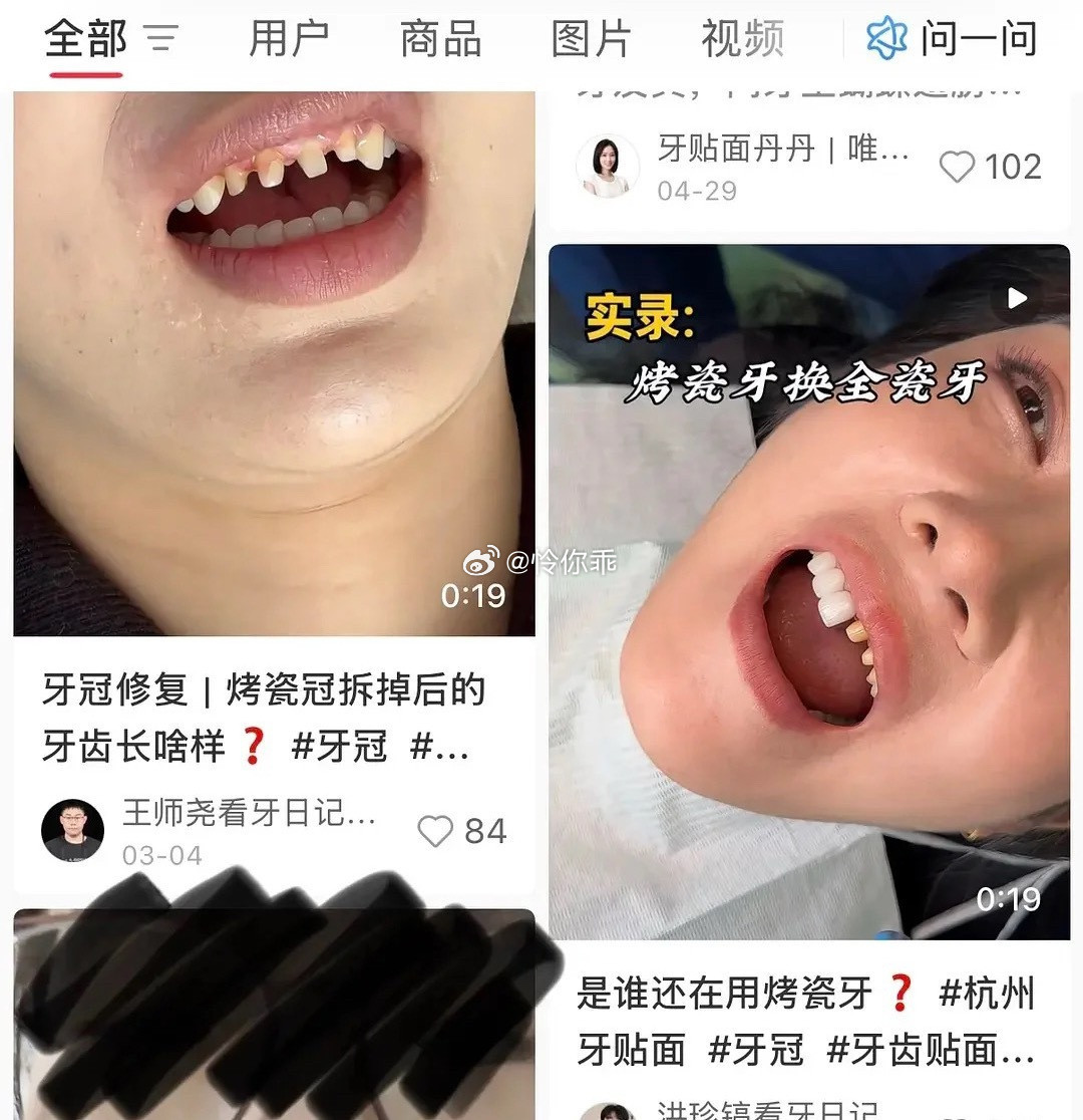 才知道烤瓷牙是要把自己的牙磨小再套牙冠好佩服做烤瓷牙的明星