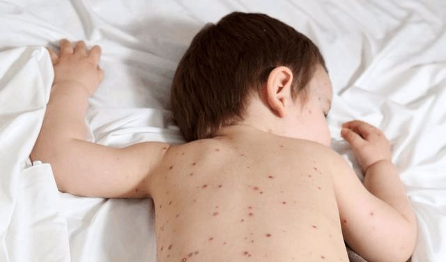 婴幼儿得皮疹如何护理, 必须做到这5点