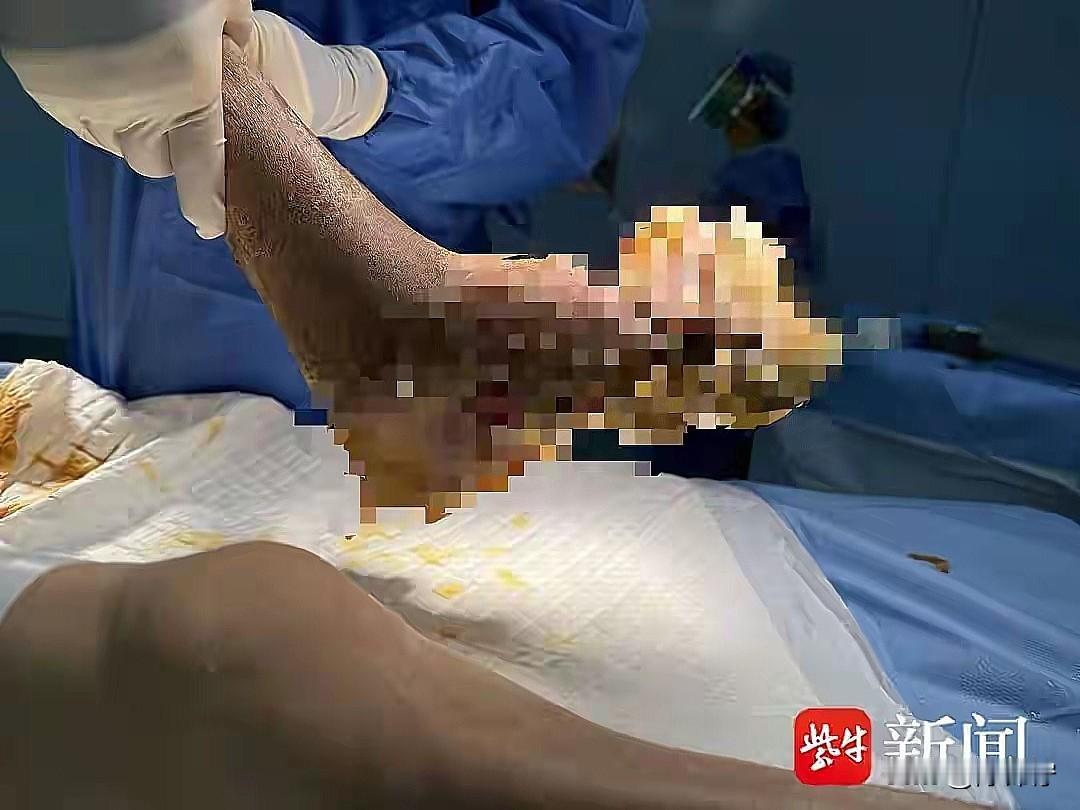 想想都头皮发麻！抠脚居然抠出满脚“菜花”，肛周还沾了边，最后查出HPV！这事儿就