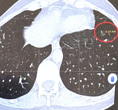 怎么判断自己是不是早期肺癌？肺原位癌、微浸润癌算早期吗？经常有网友私信问我一个很