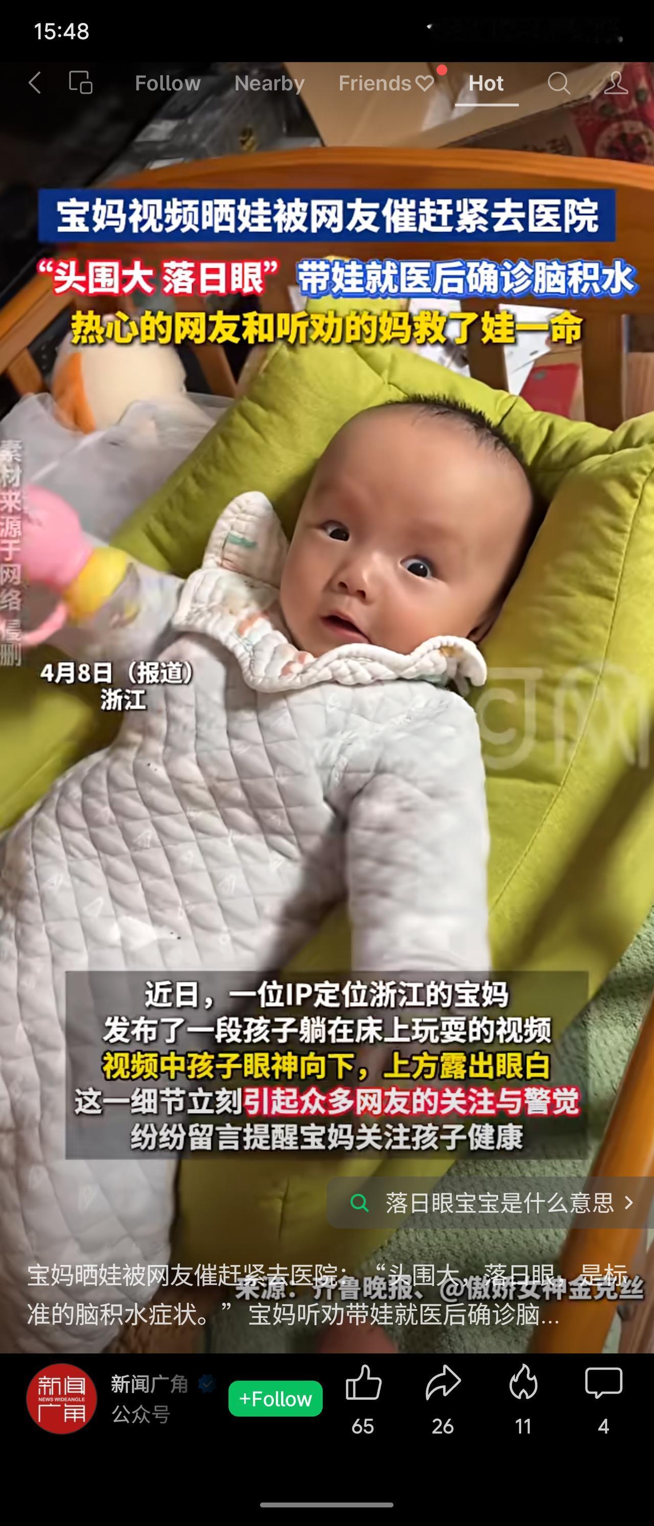 近日浙江一位宝妈晒娃视频中，孩子头围偏大且眼神下视露出眼白，网友认出这是脑积水典