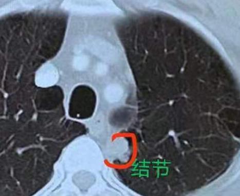 肺不好的朋友注意了！真实案例提醒：结节两年从无到长，别忽视体检！跟大家说个真实案