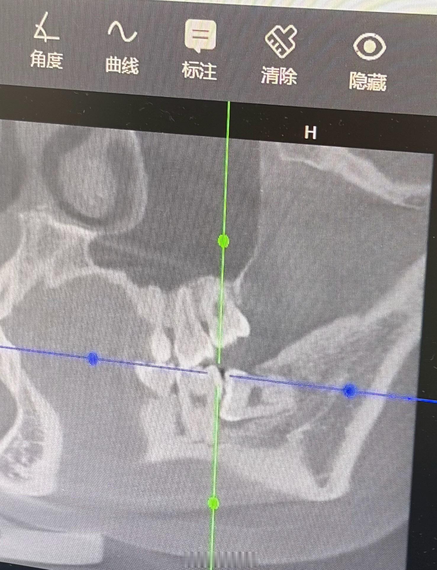 今日拔牙日记📔：以为只有两颗智齿，ct一拍竟然上下左右4颗长满！啥都没干！ct