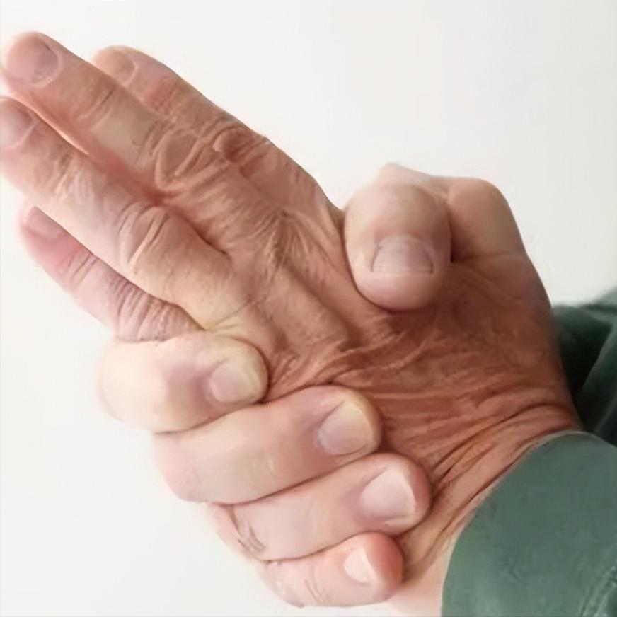 脑梗上肢恢复慢，原因竟然是这个！很多脑梗患者和家属都有一个共同的困惑：腿已经