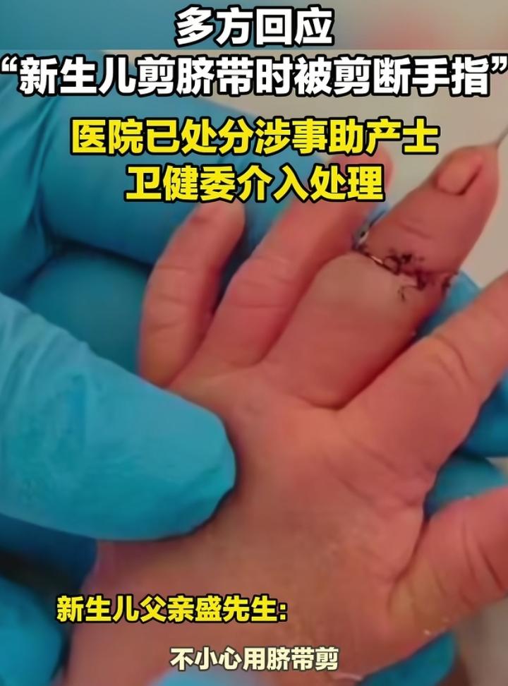 剪脐带把婴儿手指剪断这得多马虎才能出这种错误？就算不是有意的但是孩子得遭多