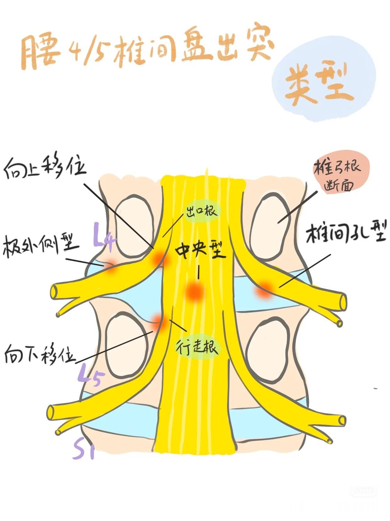 腰椎间盘突出﻿﻿【腰突分型】之前总讲，中央型突出比较特殊，很多常规训练都不建
