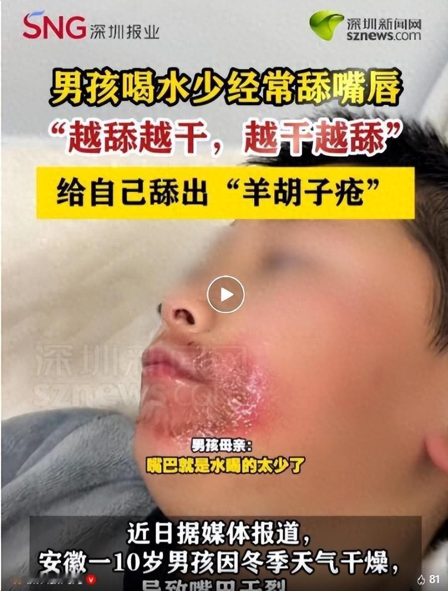 担心的事情还是发生了！安徽，一10岁男孩因冬天干燥，嘴巴干燥经常舔，结果却给自己