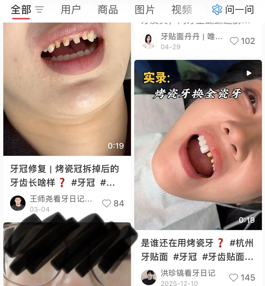 才知道烤瓷牙是要把自己的牙磨小再套牙冠😨吓人