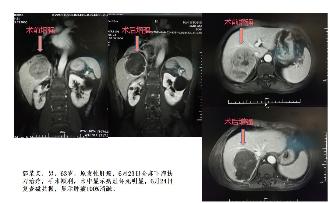 海扶刀的治疗效果如何海扶刀治疗属于局部消融治疗，效果是直接确切的，一般我们海扶刀