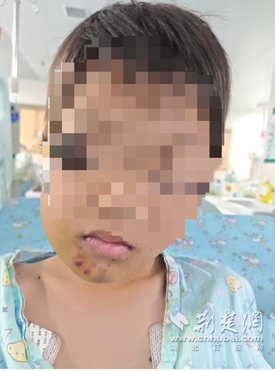 悲剧差点酿成！湖北襄阳8岁孩子江边踩水玩耍，突然被毒蛇咬住嘴唇，救治过程步步惊险