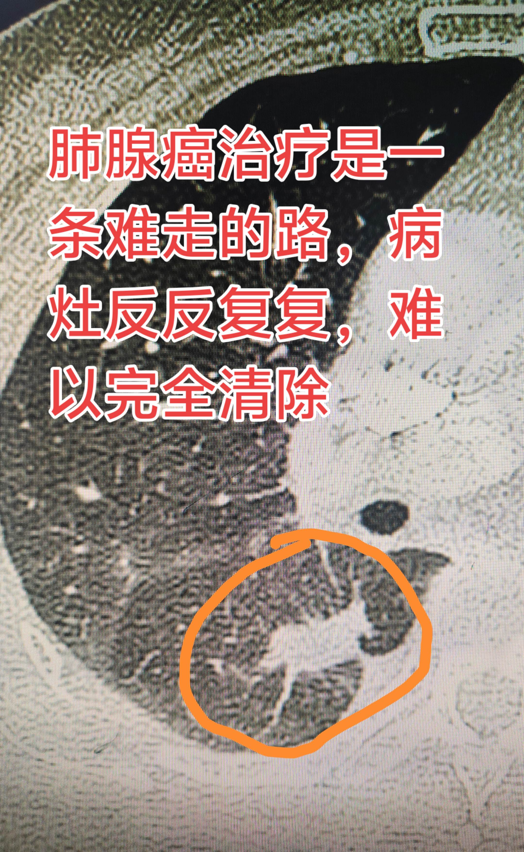 肺癌的治疗。肺腺癌治疗是一条难走的路，病灶反反复复，难以清除