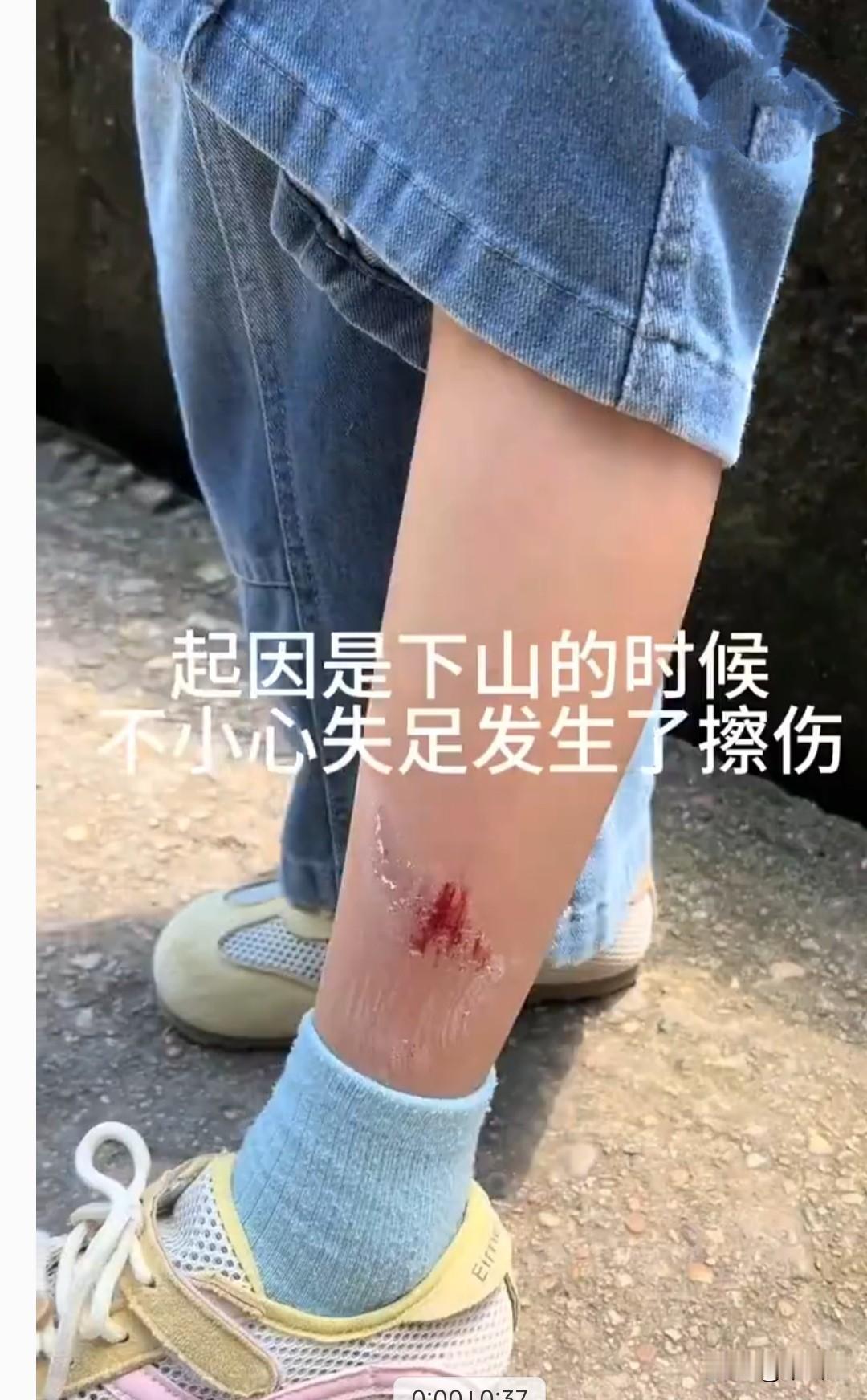 女子带着小孩去爬山，下山时，孩子不小心失足，小腿被擦伤，皮被蹭破还流了血。路过