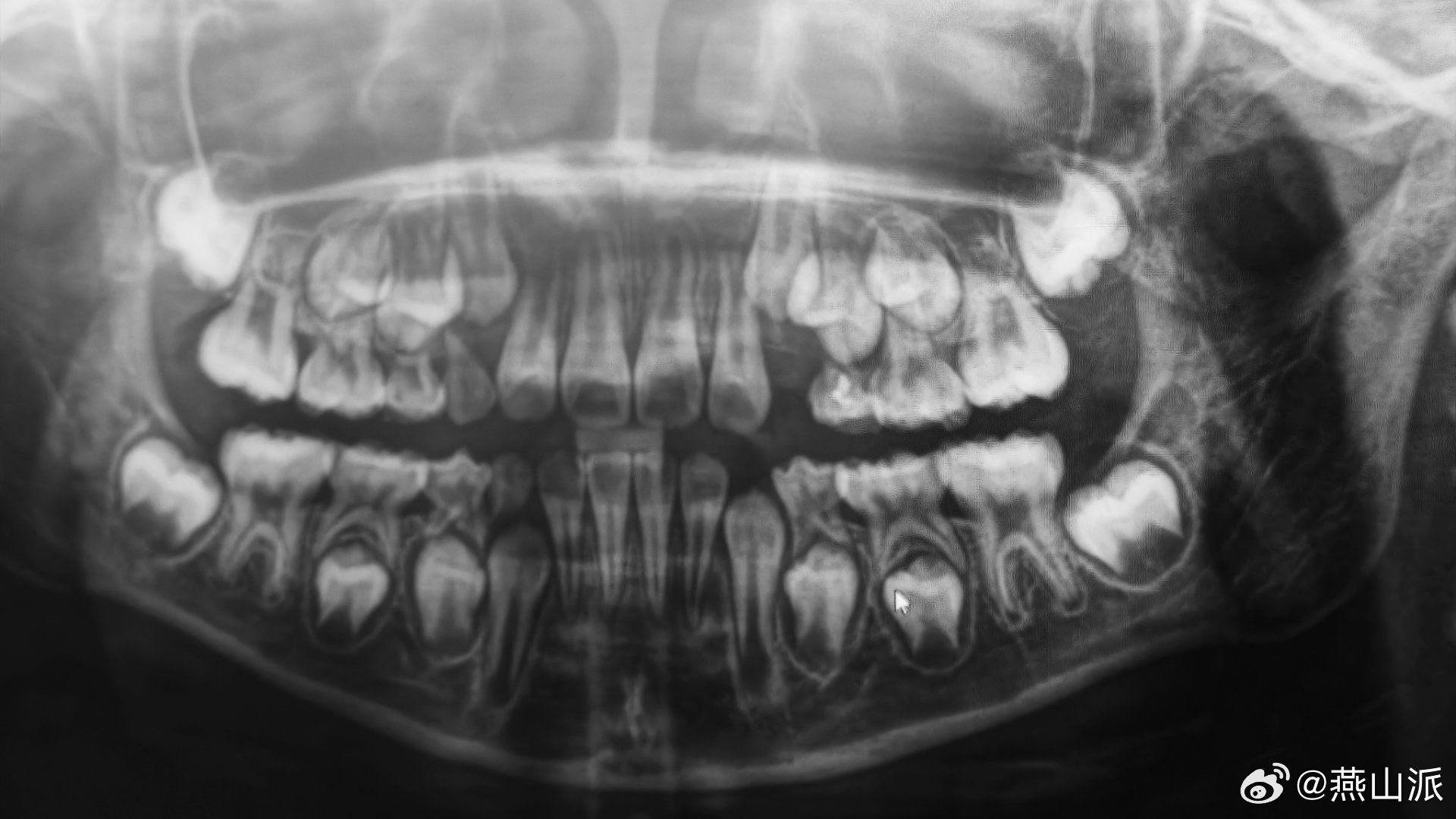 “乳牙是被恒牙顶掉的”这一刻是不是具象化了？