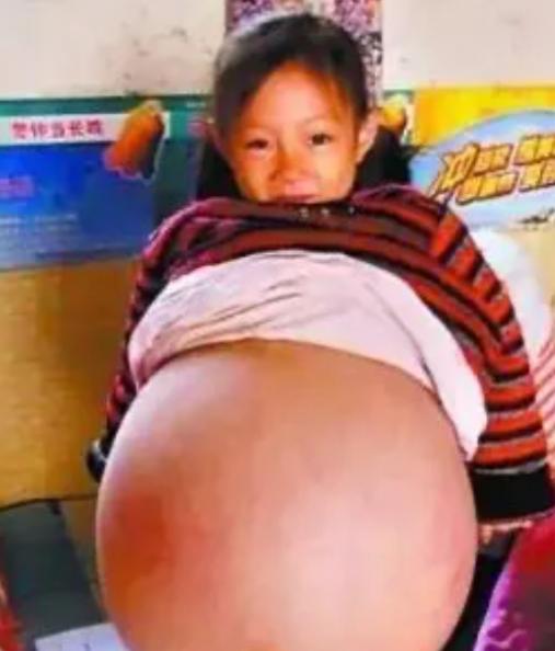 山西一名4岁小女孩，肚子异常鼓胀，大得像足月孕妇。多家医生轮番诊断，残酷预言她活