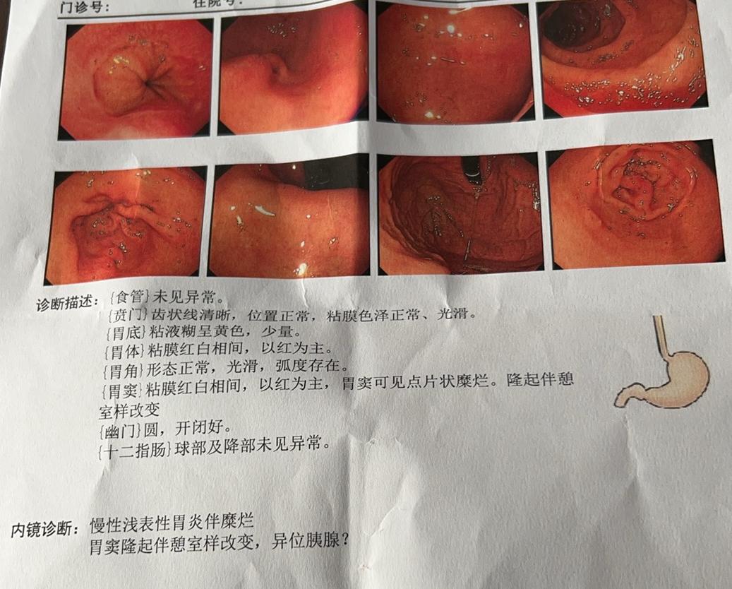 胃镜体验：喉咙今日限行！一大早去做了个普通胃镜，感觉嘛…还行！就是差点变成人