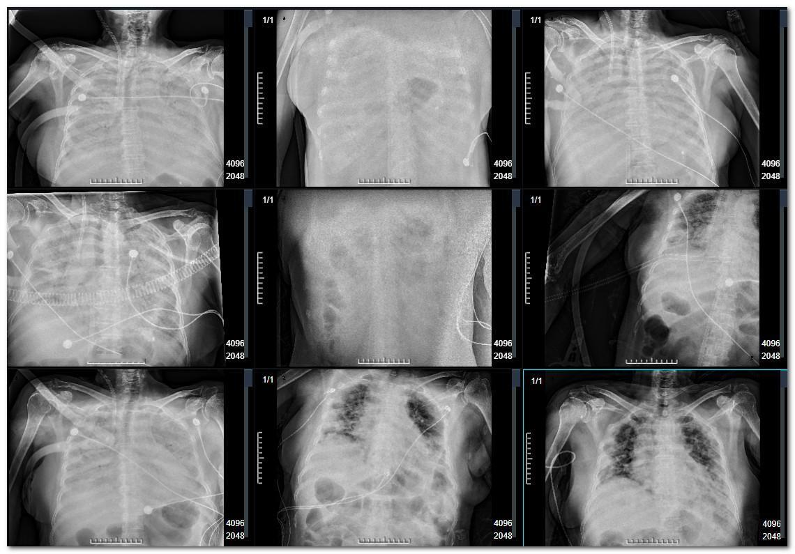 报告里出现死亡信号，医生预言一周内出现生命危险，最后丝毫不差肺癌是最让人害怕的