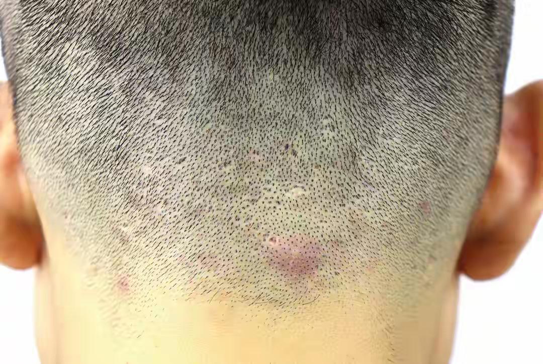 脂溢性皮炎加毛囊炎什么东西不能吃？每天头皮很痒，洗完了很快就油腻了，我个人觉得首