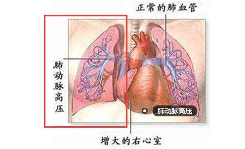 蓝嘴唇肺动脉高压是罕见病? 临床漏诊率高犯病有多凶险?