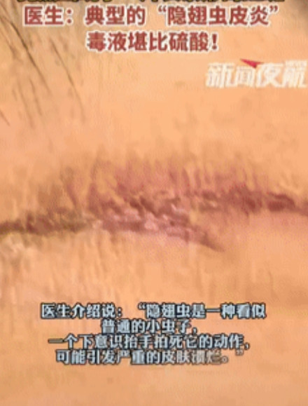 万万没想到！浙江，一女子回老家村里住，不料突然感觉脖子后面一痒，她随手摸了一下
