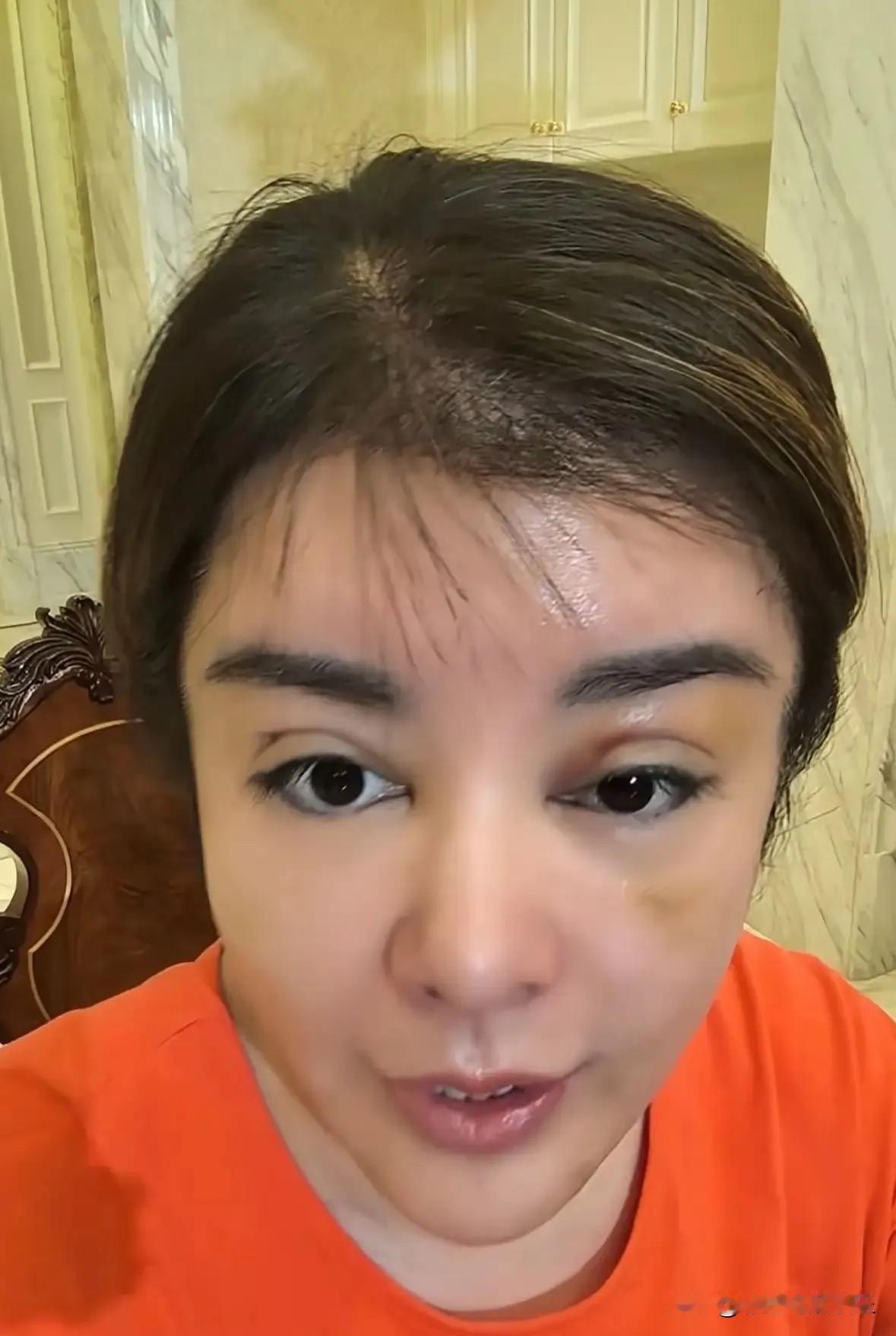 整容的尽头就是于文红，原来关了美颜滤镜的于文红早就毁容了，她是医美的反面教材。