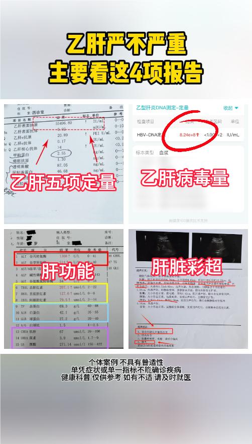 乙肝严不严重，主要看这4项报告。①乙肝五项定量：也叫 “两对半”，能判...