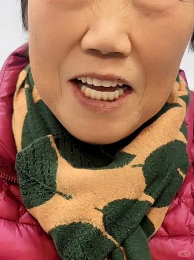 在成都种植全口牙，还得是华西专家
