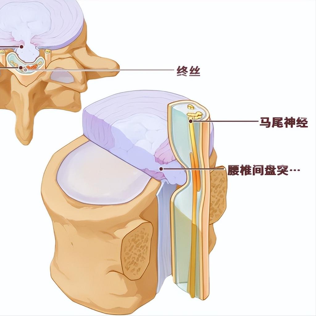马尾神经千万别拖！三个致命信号要知道第一个信号：足下垂，能走路但脚抬不起走