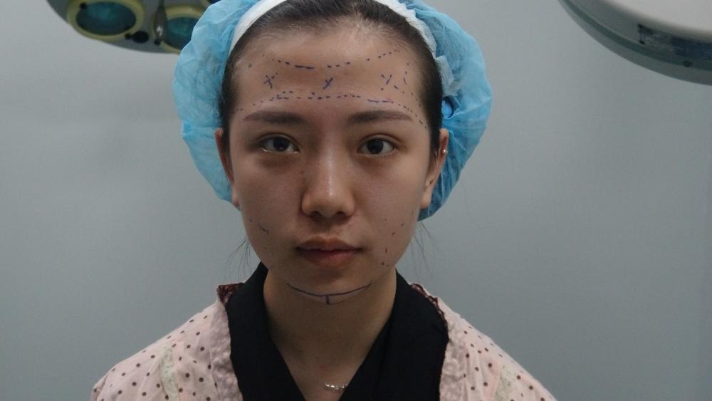 自体脂肪填充额头+硅胶垫下巴手术案例