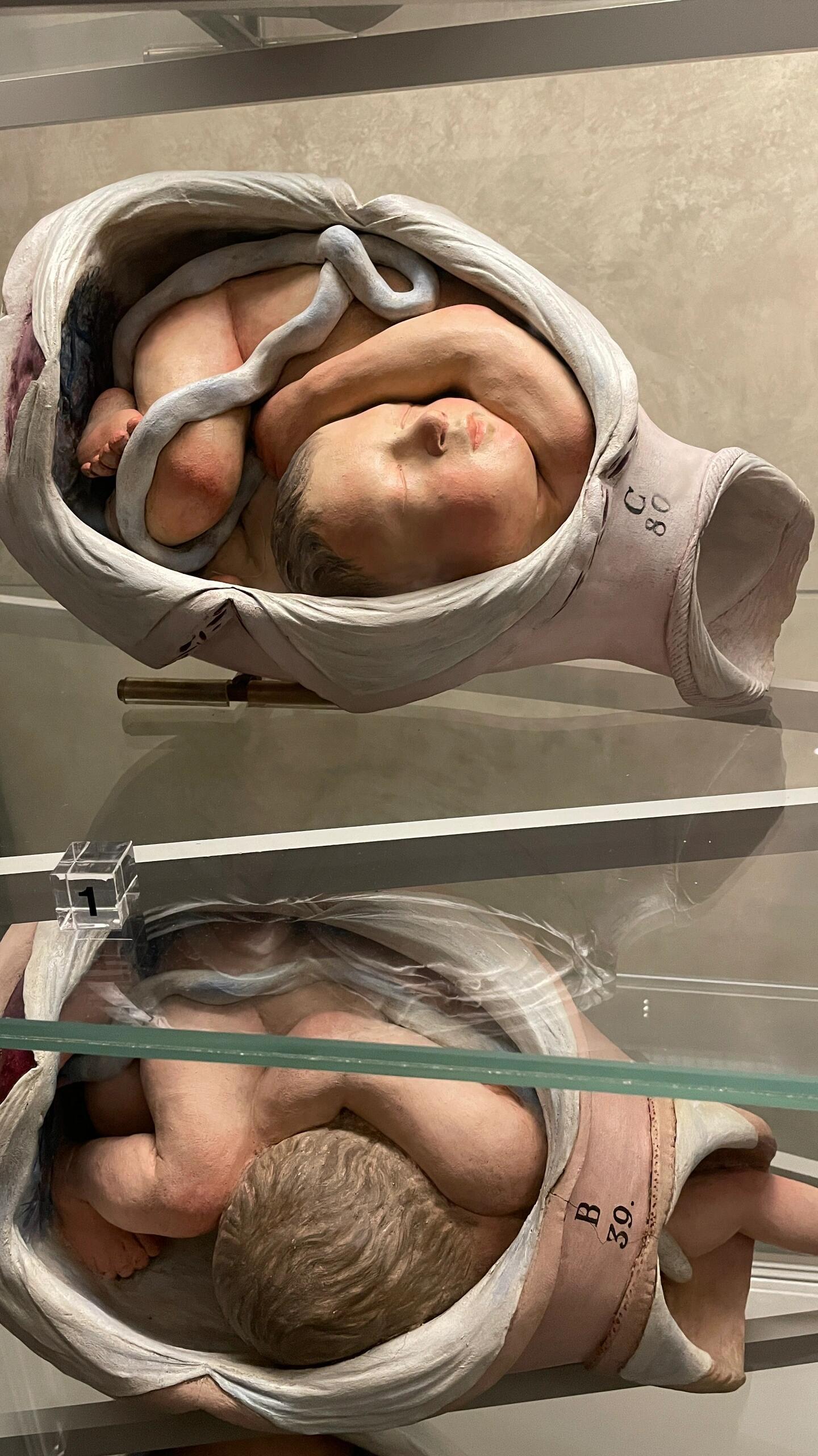 胎位不正好吓人啊