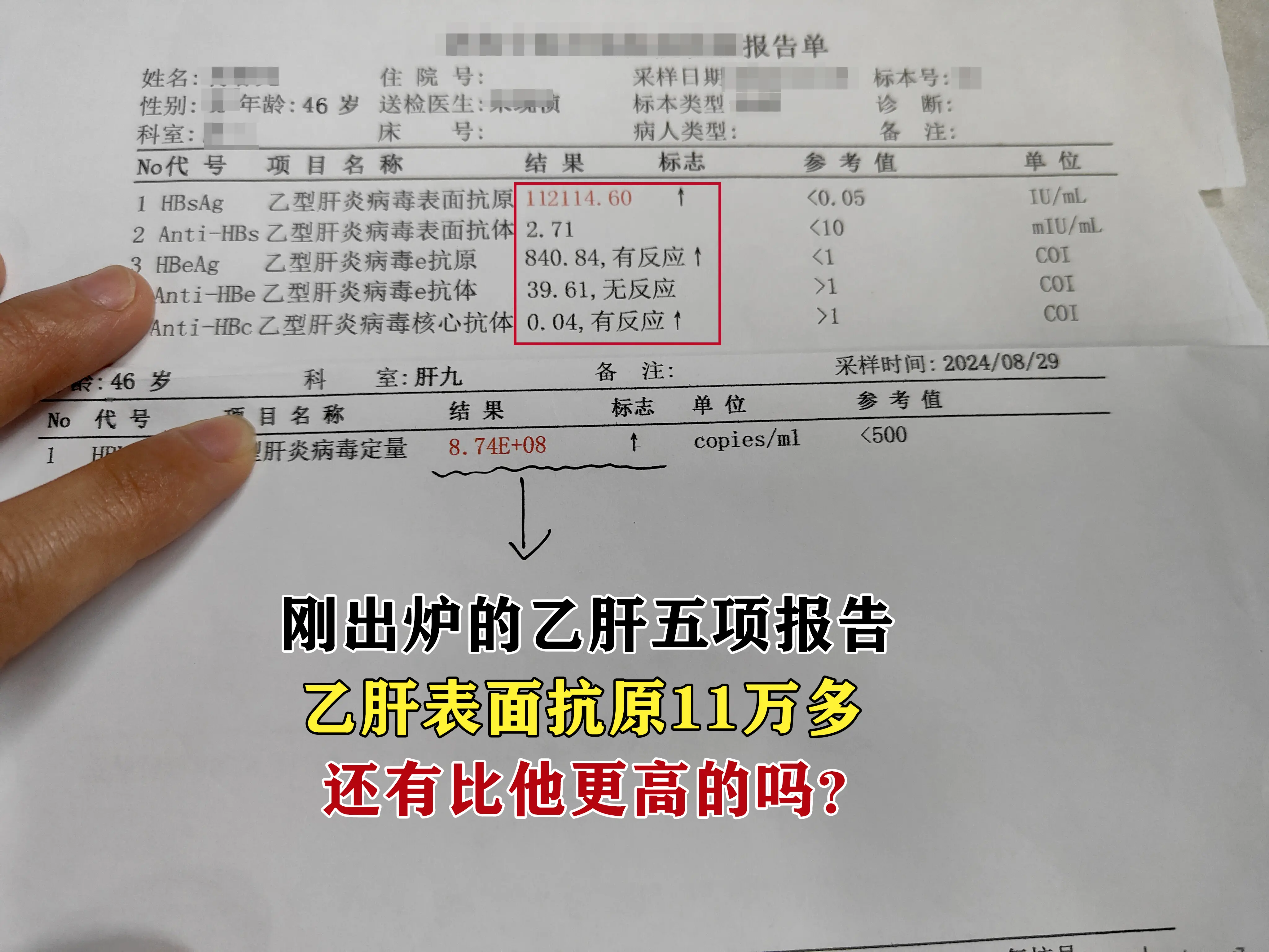 刚出炉的乙肝五项报告，表面抗原高达11万多，病毒量8次方，这个数值一定...