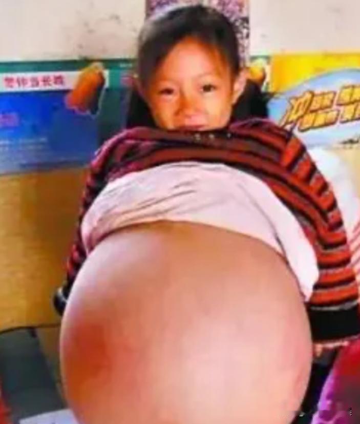 山西一四岁小女孩，因肚子鼓得像孕妇一样大成了村里的“特殊存在”。医生断言最多撑