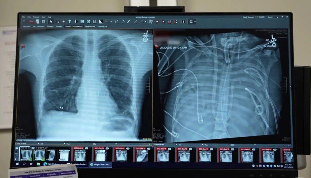 无肺存活数天！一场逆天手术，改写重症急救天花板一场普通流感，竟让年轻男子双肺彻